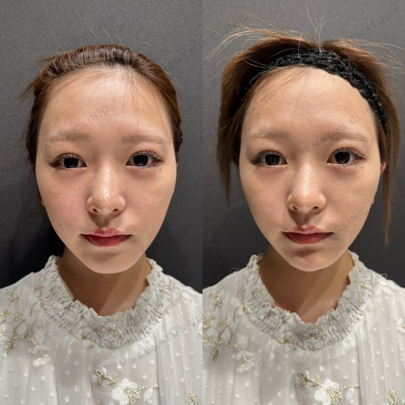 顎ヒアルロン酸ボラックス症例写真