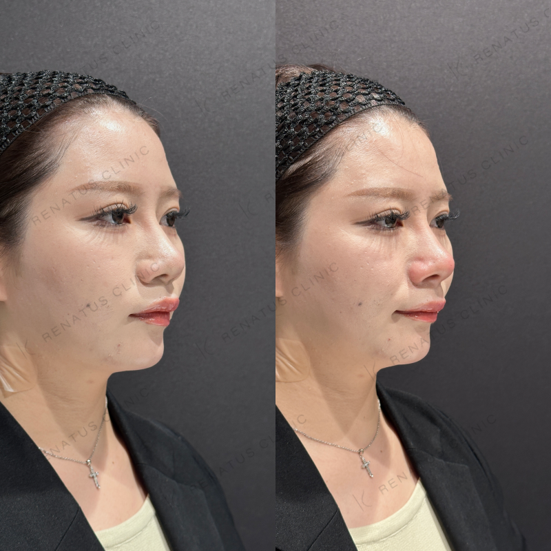 鼻中隔ヒアルロン酸ボラックス症例写真