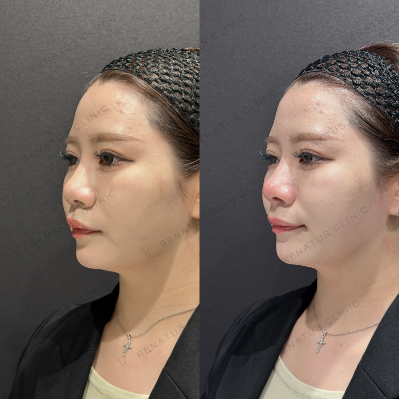 鼻中隔ヒアルロン酸ボラックス症例写真
