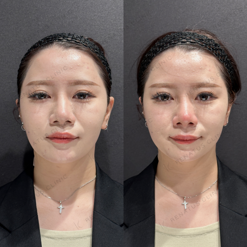 鼻中隔ヒアルロン酸ボラックス症例写真
