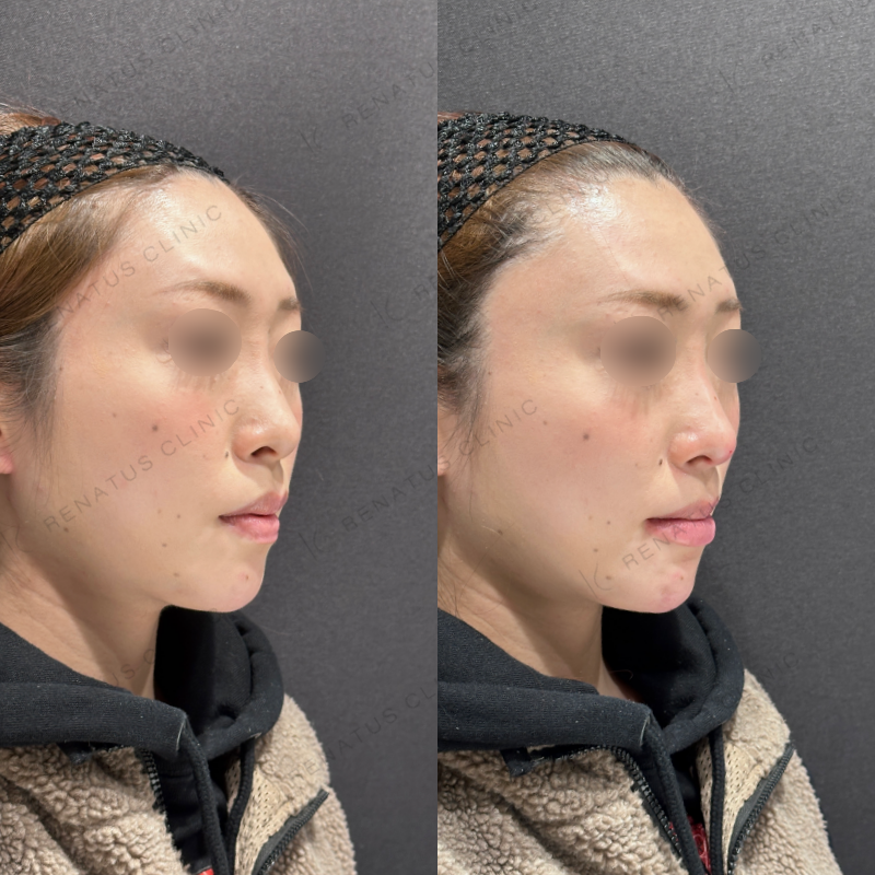 鼻・唇・顎ヒアルロン酸ボラックス・ボルベラ・ボラックス症例写真