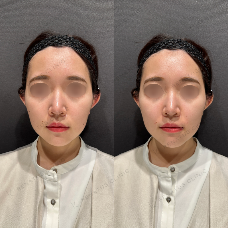鼻翼基部ヒアルロン酸ボリフト症例写真