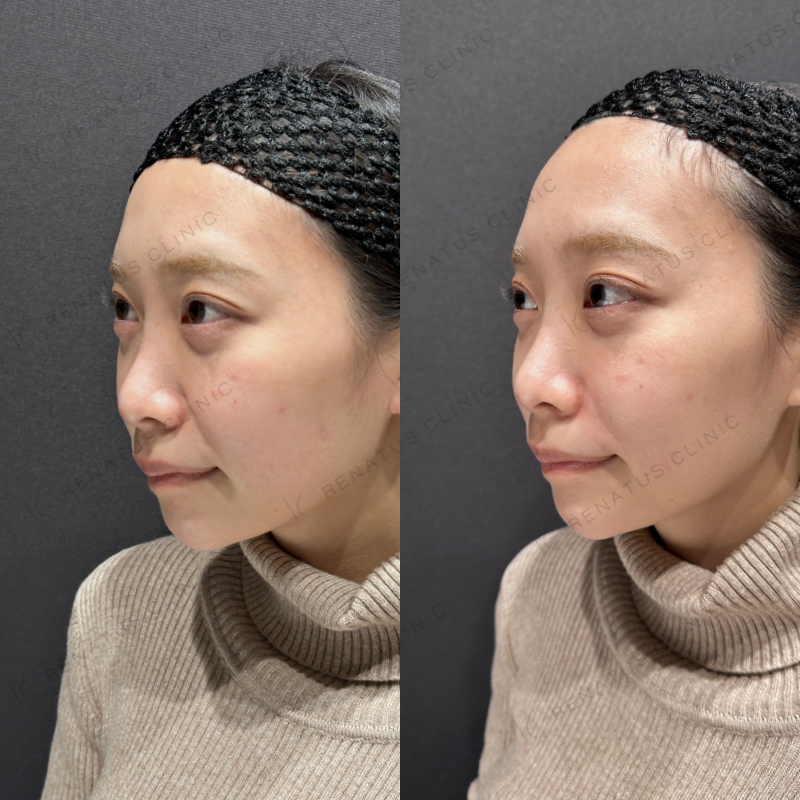 鼻翼基部ヒアルロン酸ボリューマ症例写真