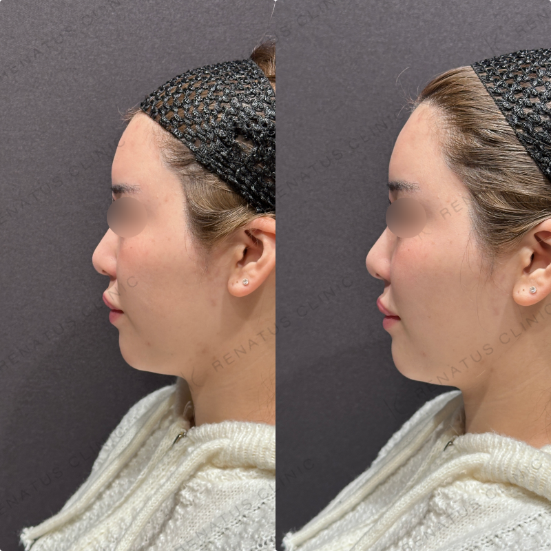鼻翼基部ヒアルロン酸ボリューマ症例写真