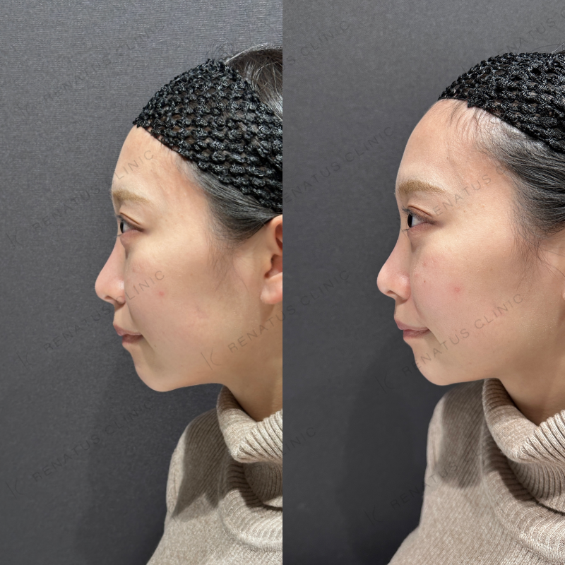 鼻翼基部ヒアルロン酸ボリューマ症例写真