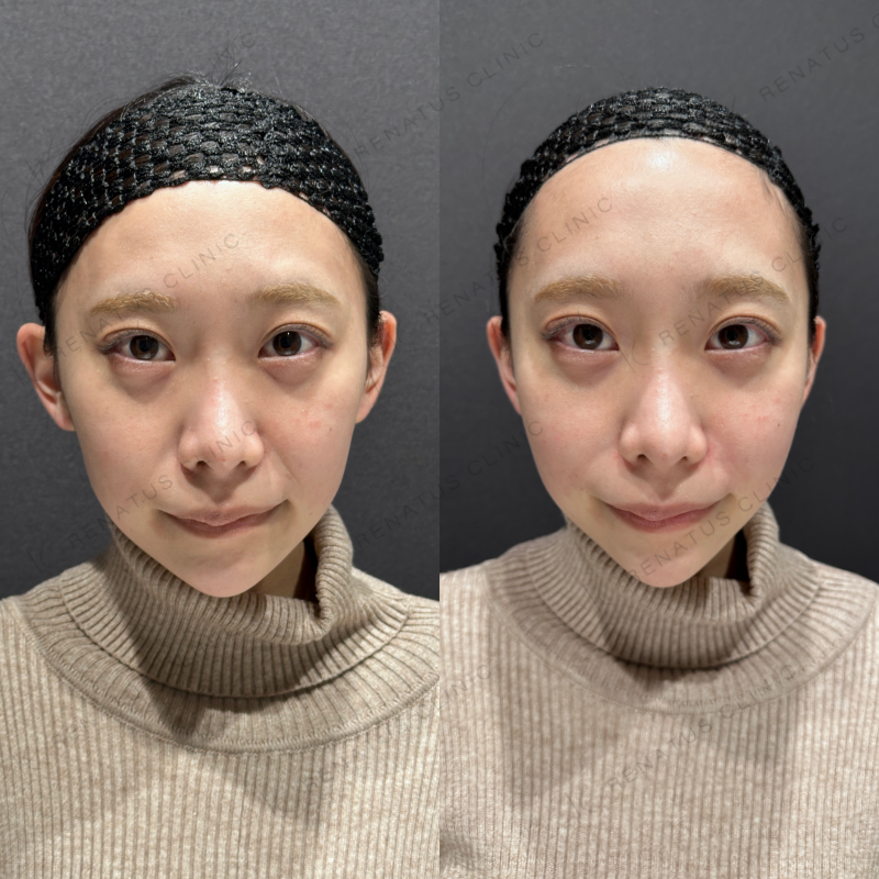 鼻翼基部ヒアルロン酸ボリューマ症例写真