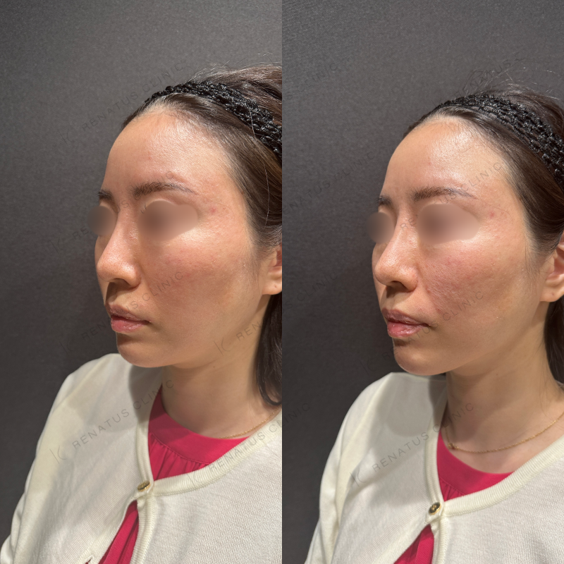 ほうれい線・鼻翼基部ヒアルロン酸ボリフト症例写真
