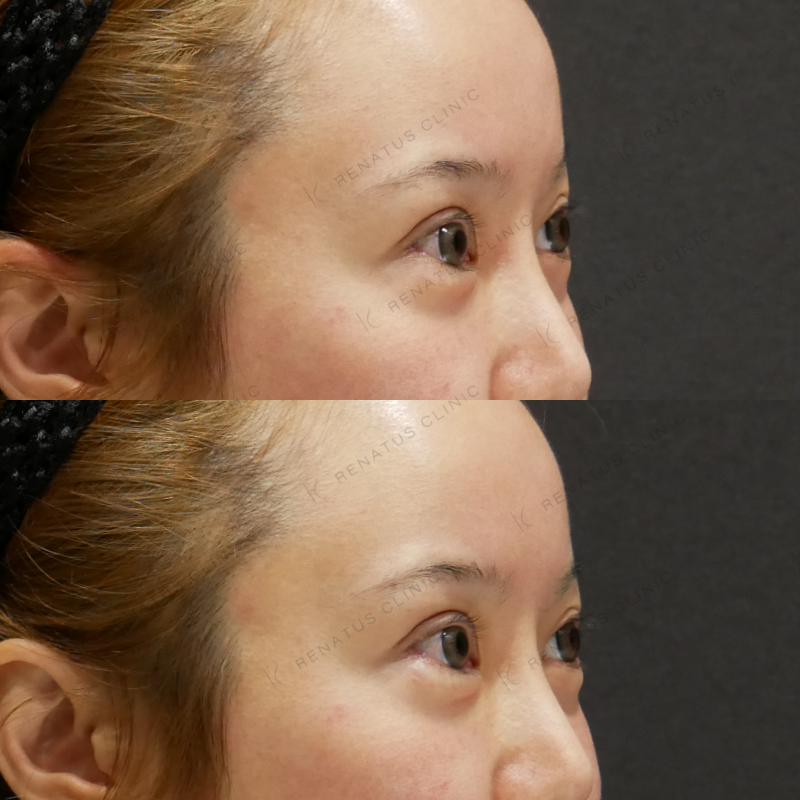 涙袋ヒアルロン酸ボルベラ症例写真