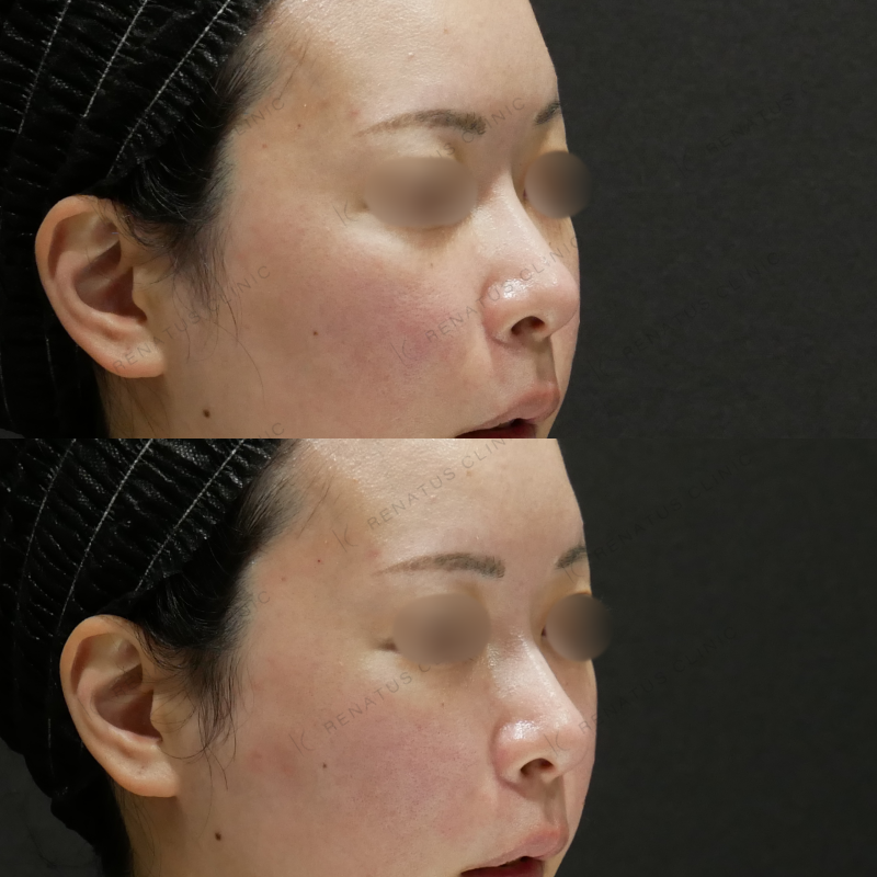 鼻翼基部ヒアルロン酸ボリフト症例写真