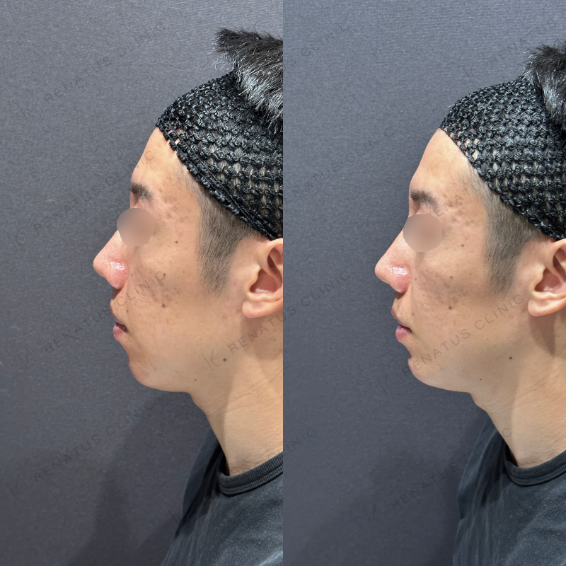 顎ヒアルロン酸ボラックス症例写真
