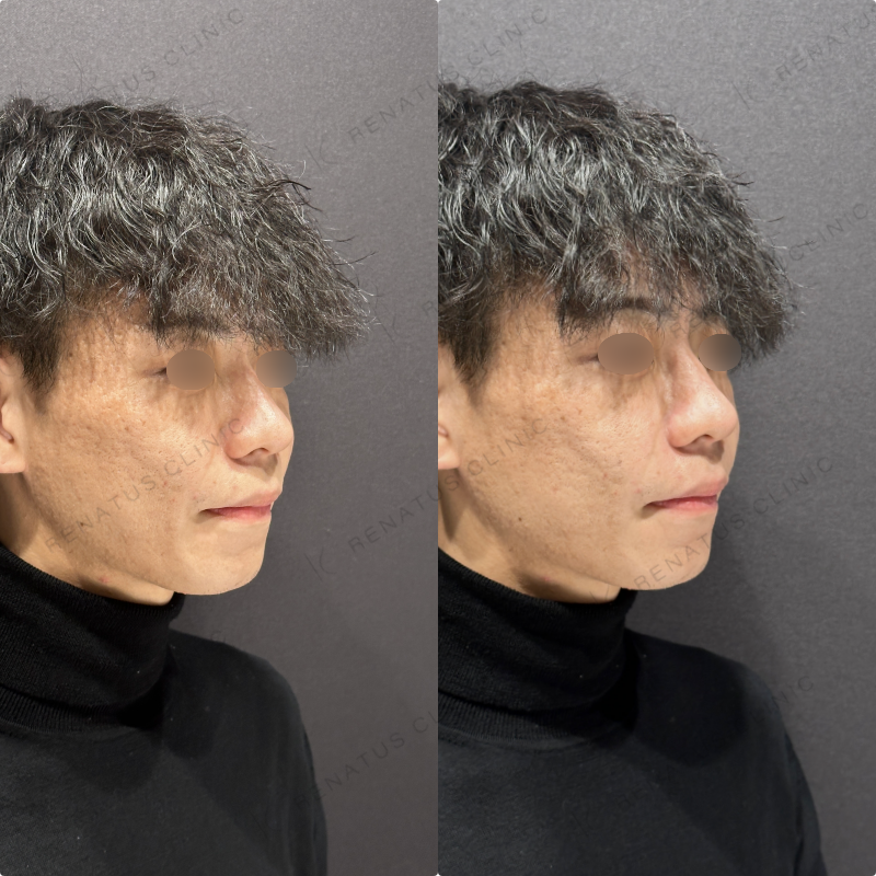 ほうれい線ヒアルロン酸ボリフト症例写真