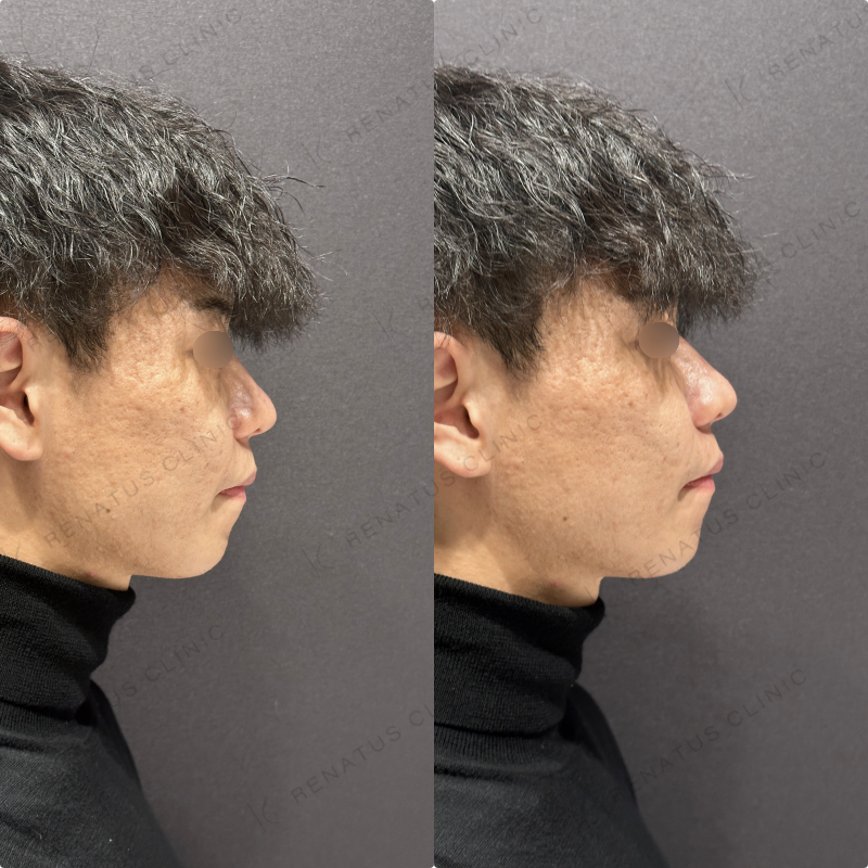 ほうれい線ヒアルロン酸ボリフト症例写真