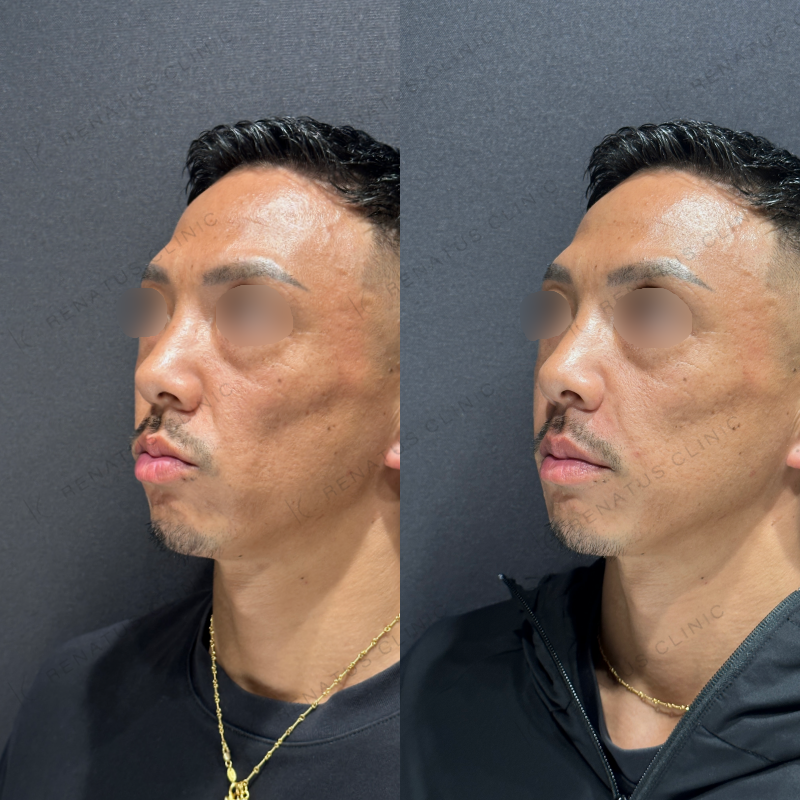 ほうれい線ヒアルロン酸ボリフト症例写真