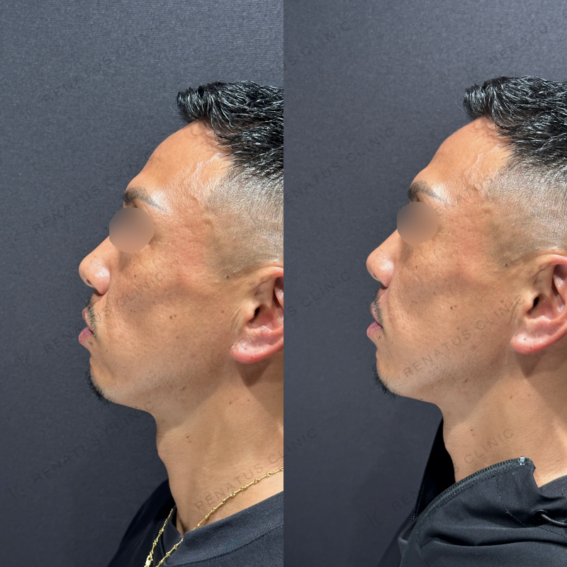 ほうれい線ヒアルロン酸ボリフト症例写真