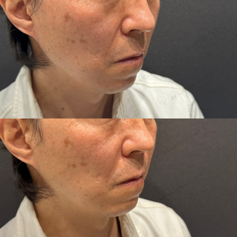 ほうれい線・ゴルゴラインヒアルロン酸ボリフト症例写真