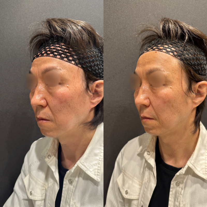 ほうれい線・ゴルゴラインヒアルロン酸ボリフト症例写真