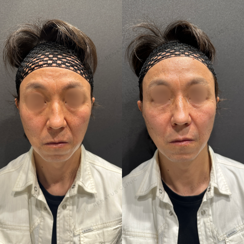 ほうれい線・ゴルゴラインヒアルロン酸ボリフト症例写真