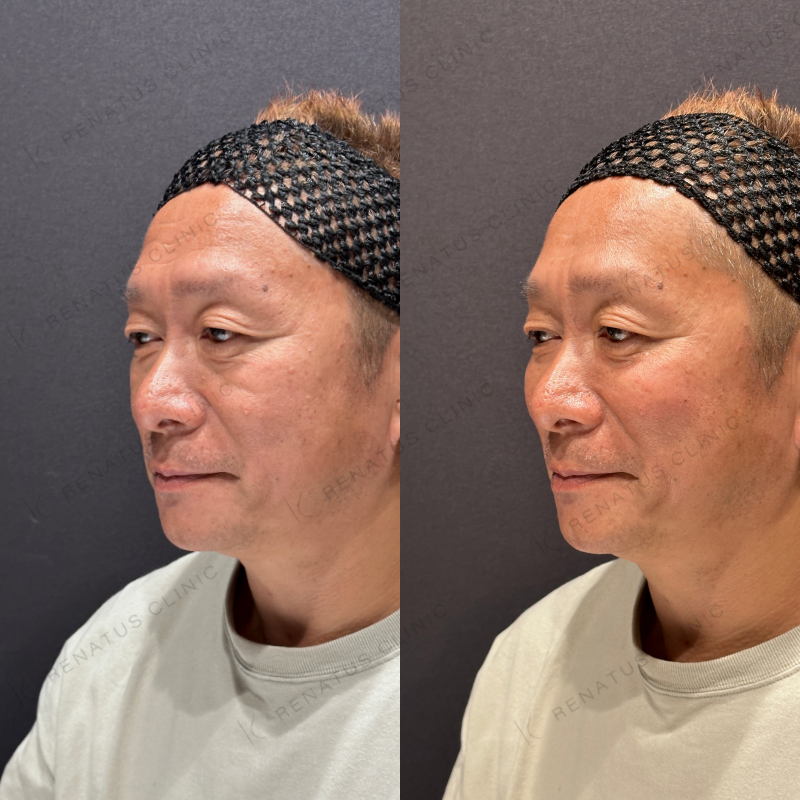 ゴルゴラインヒアルロン酸ボリフト症例写真