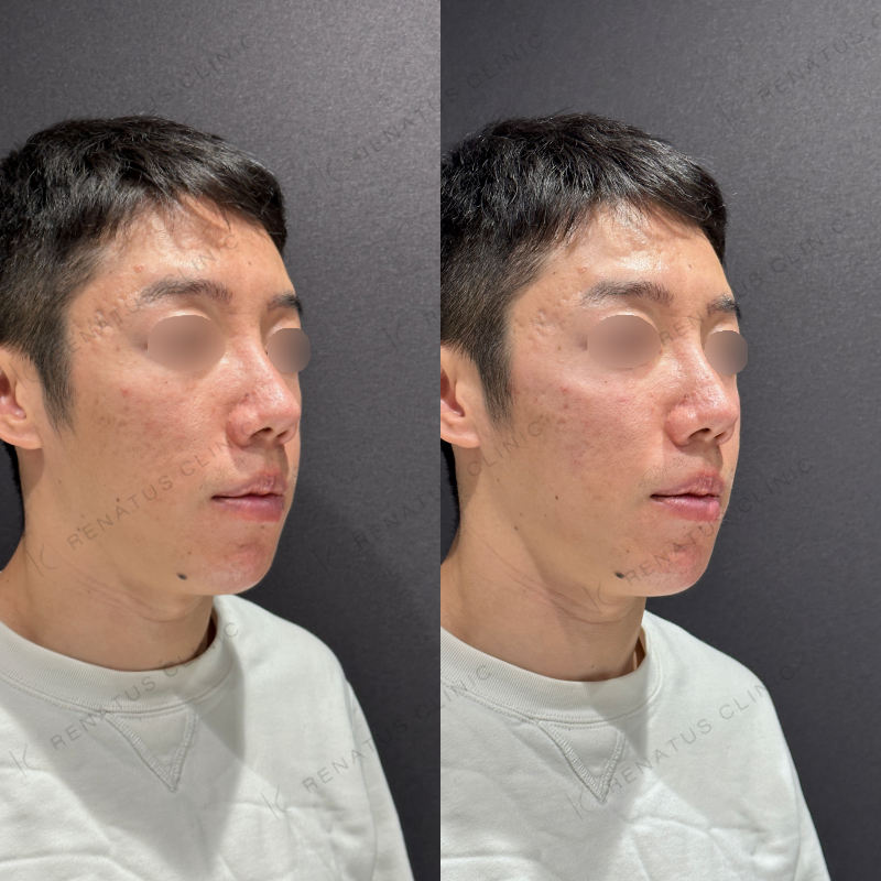 頬ヒアルロン酸ボリューマ症例写真