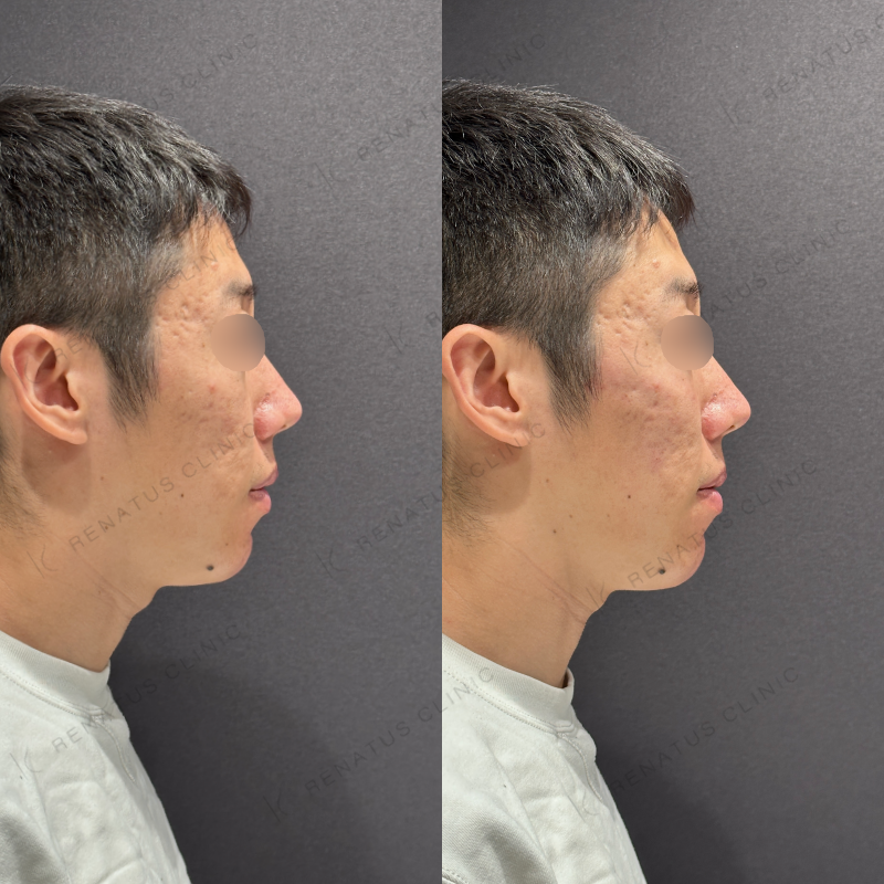 頬ヒアルロン酸ボリューマ症例写真