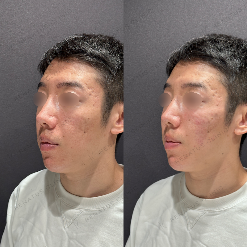 頬ヒアルロン酸ボリューマ症例写真