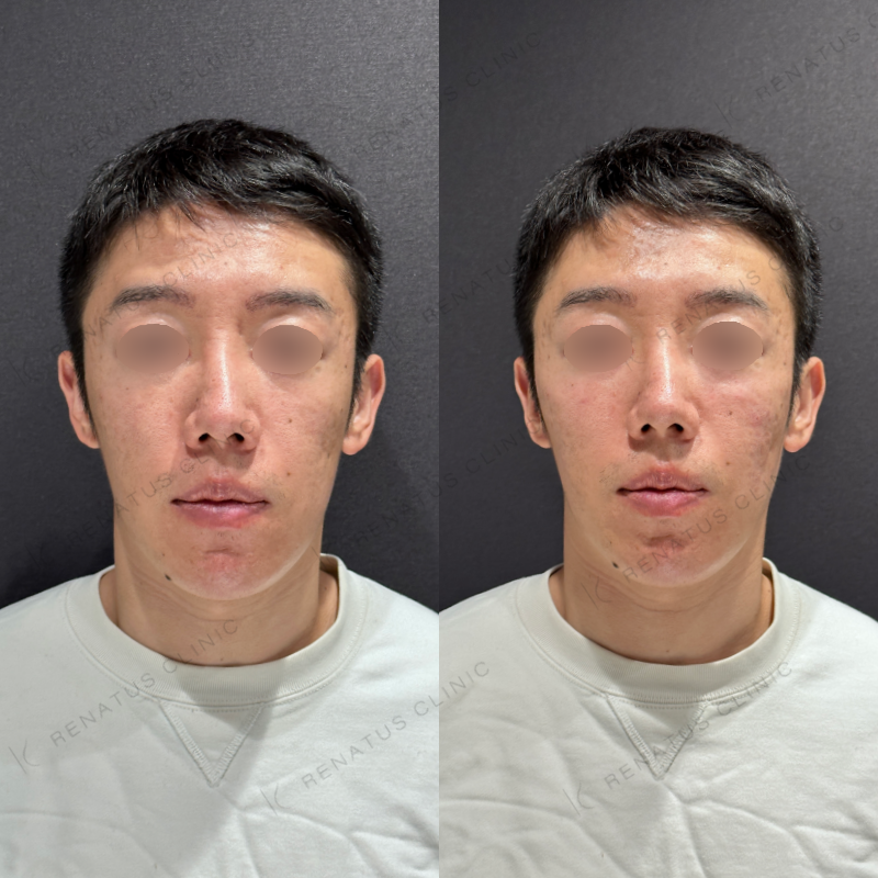 頬ヒアルロン酸ボリューマ症例写真