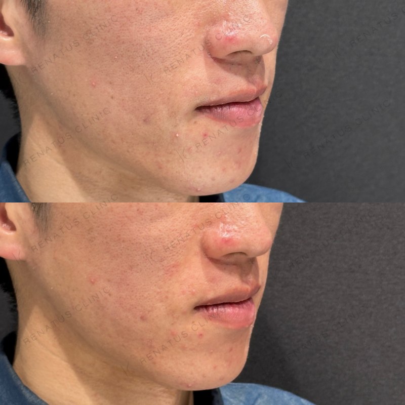 頬コケヒアルロン酸ボリフト症例写真