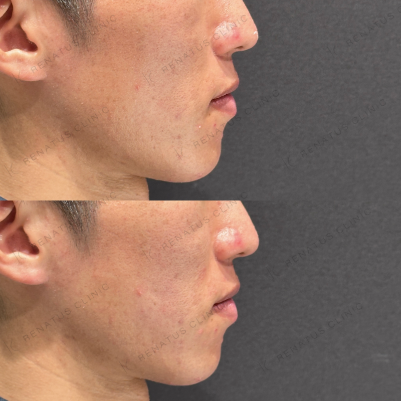 頬コケヒアルロン酸ボリフト症例写真