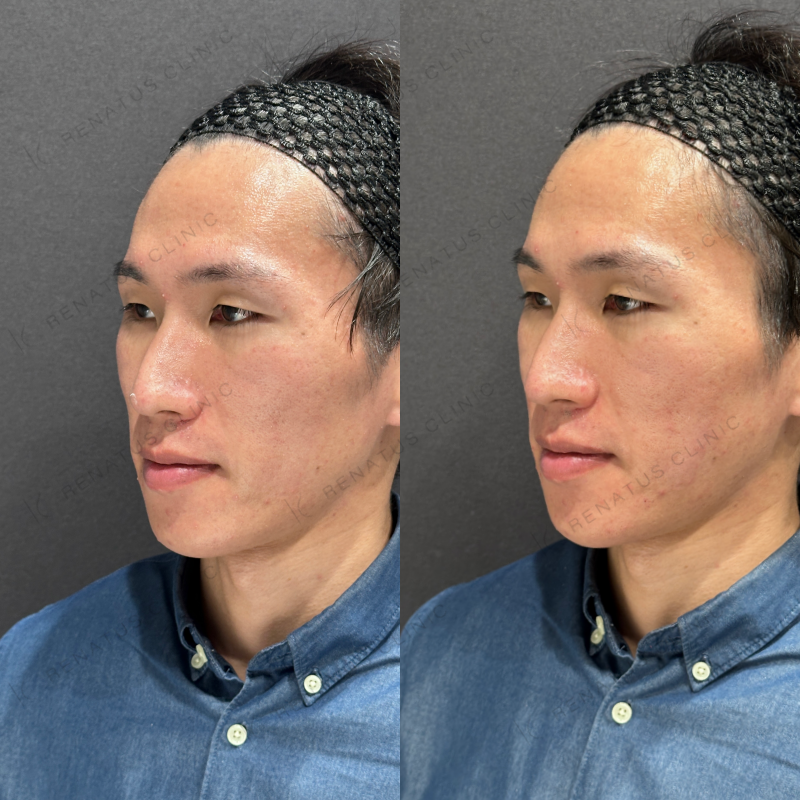 頬コケヒアルロン酸ボリフト症例写真