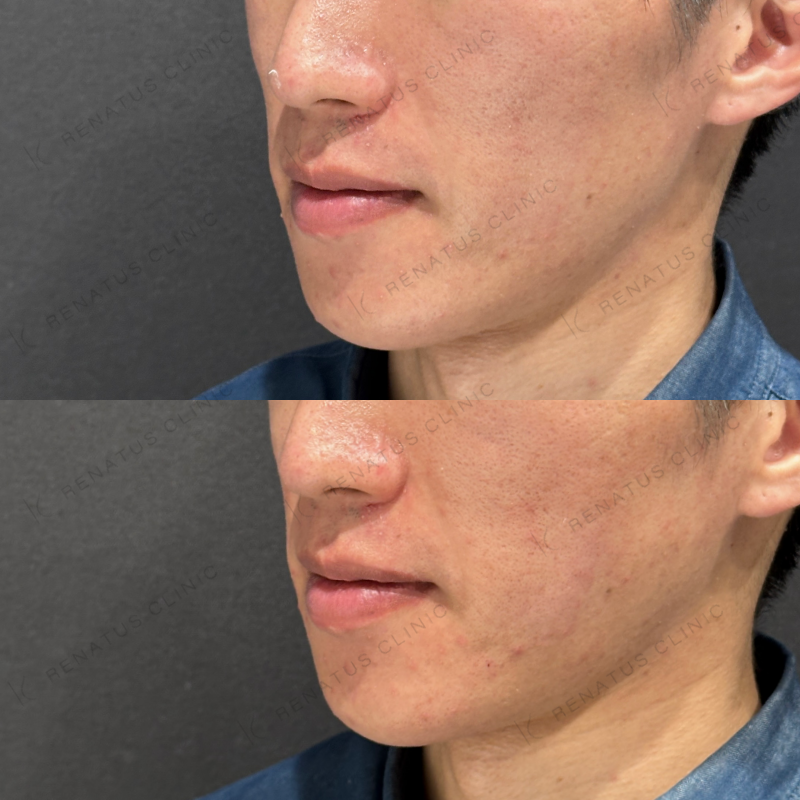 頬コケヒアルロン酸ボリフト症例写真