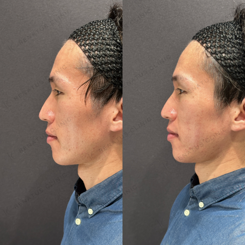 頬コケヒアルロン酸ボリフト症例写真