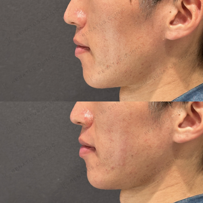 頬コケヒアルロン酸ボリフト症例写真