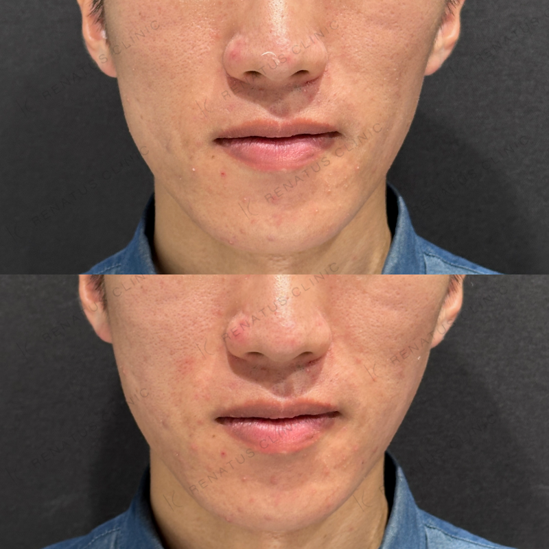 頬コケヒアルロン酸ボリフト症例写真