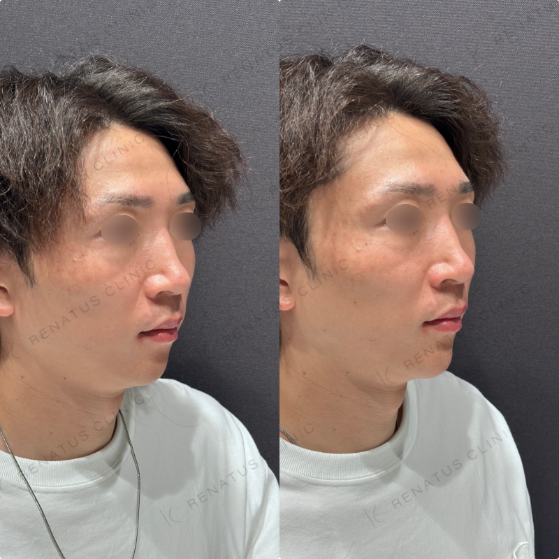 顎ヒアルロン酸ボラックス症例写真