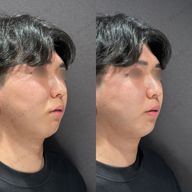 顎ヒアルロン酸ボラックス症例写真