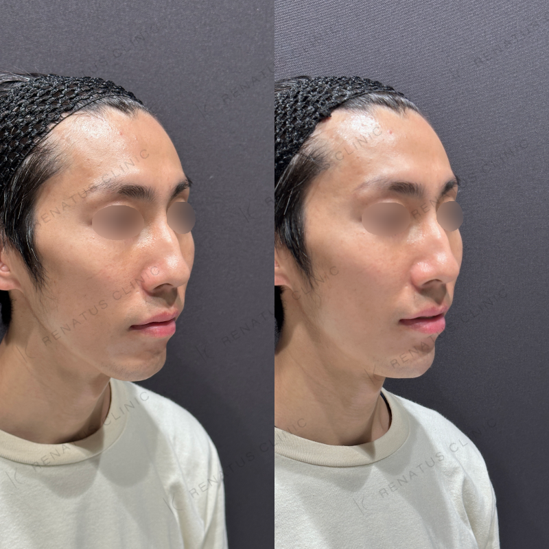 顎ヒアルロン酸ボラックス症例写真