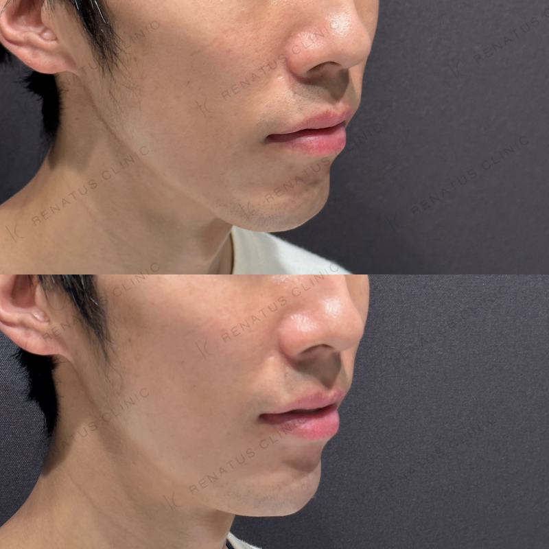 顎ヒアルロン酸ボラックス症例写真