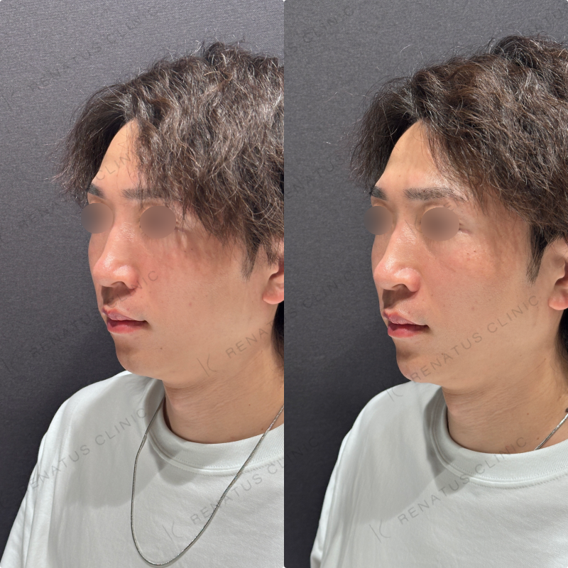 顎ヒアルロン酸ボラックス症例写真