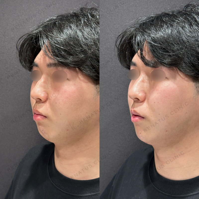 顎ヒアルロン酸ボラックス症例写真