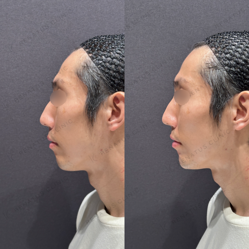 顎ヒアルロン酸ボラックス症例写真
