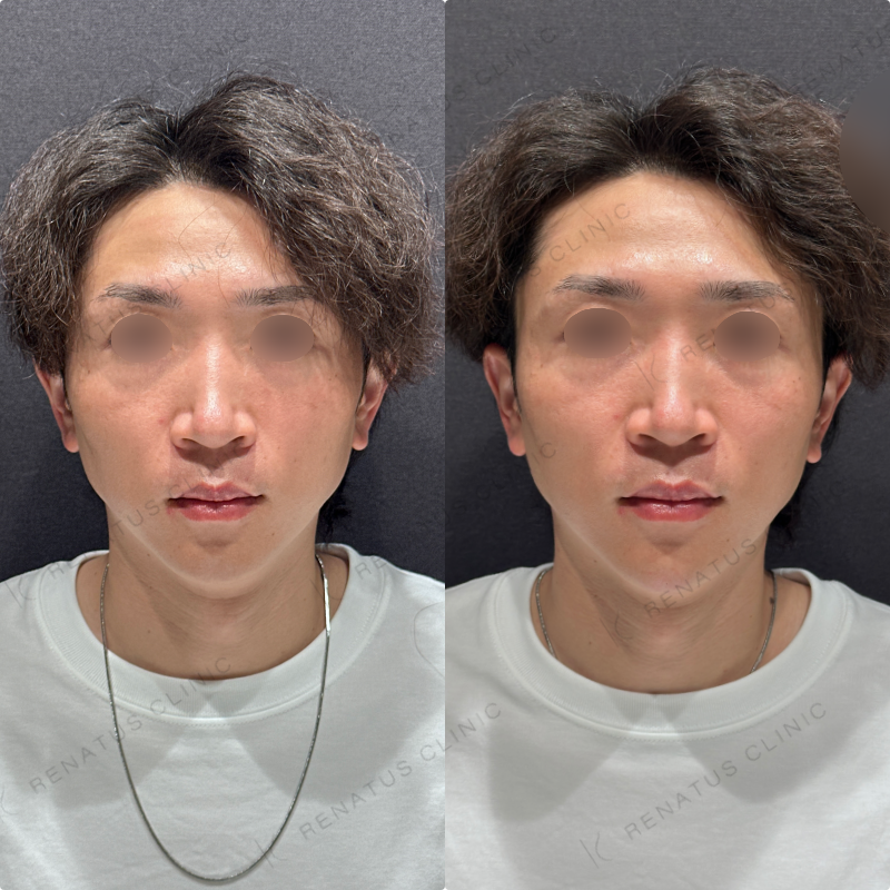 顎ヒアルロン酸ボラックス症例写真