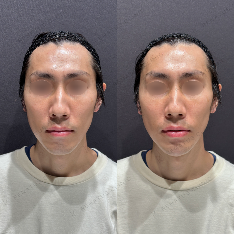顎ヒアルロン酸ボラックス症例写真