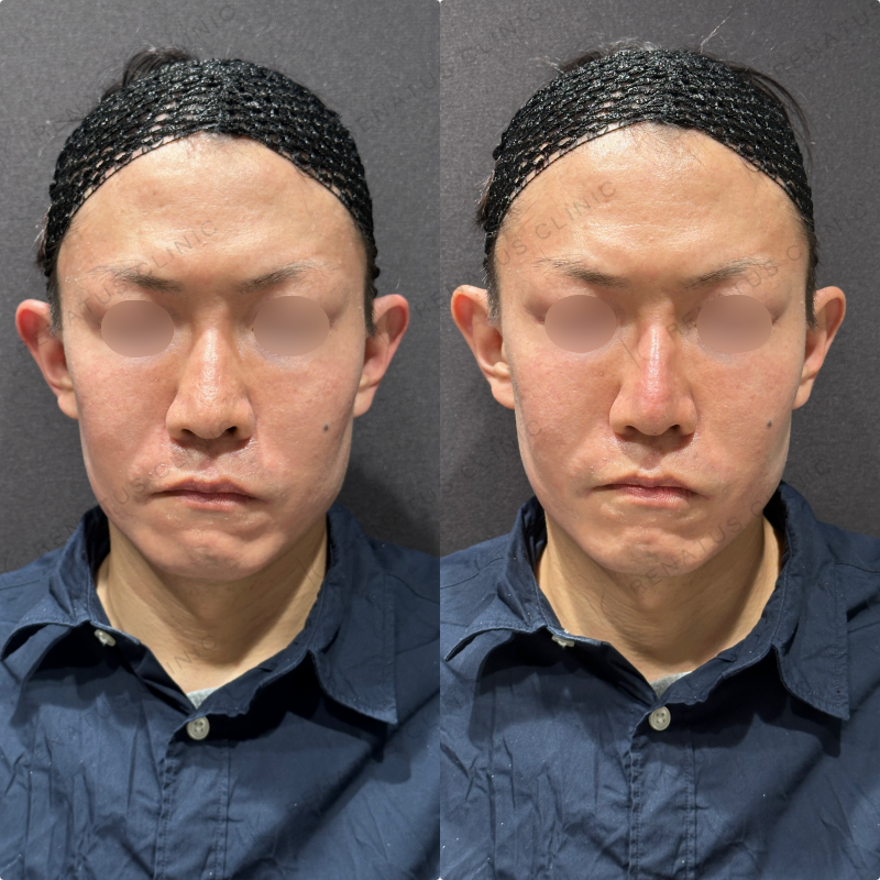 鼻ヒアルロン酸ボラックス症例写真