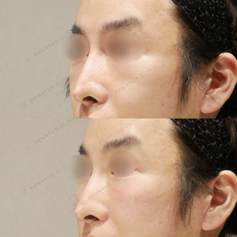 ゴルゴラインヒアルロン酸ボリューマ症例写真