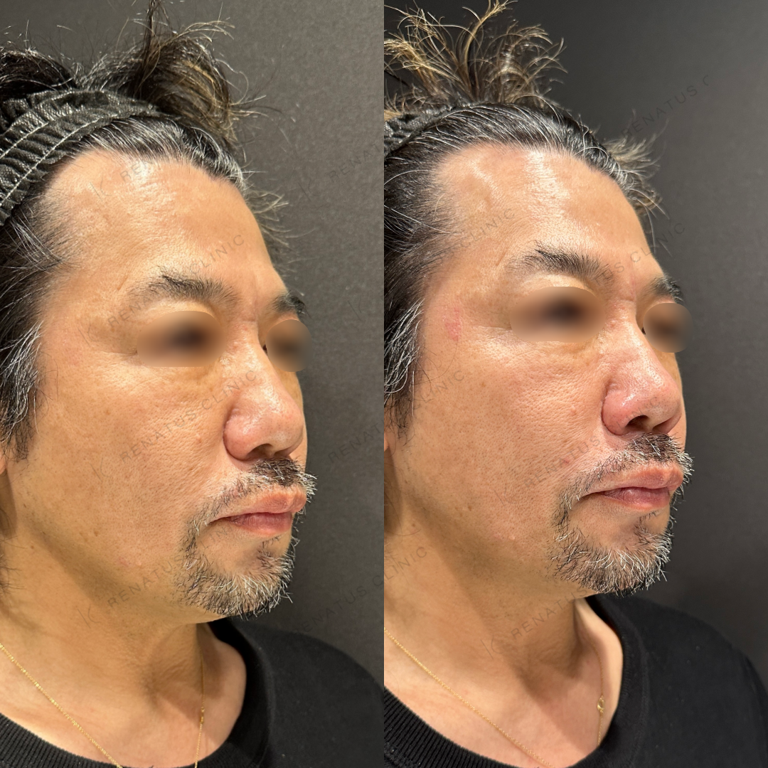鼻翼基部ヒアルロン酸ボリフト症例写真