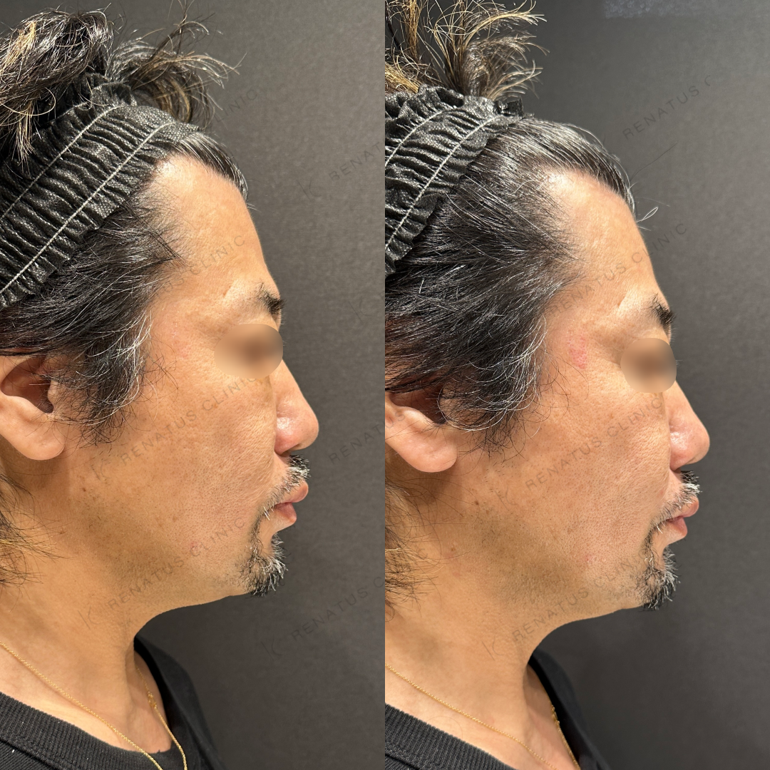 鼻翼基部ヒアルロン酸ボリフト症例写真