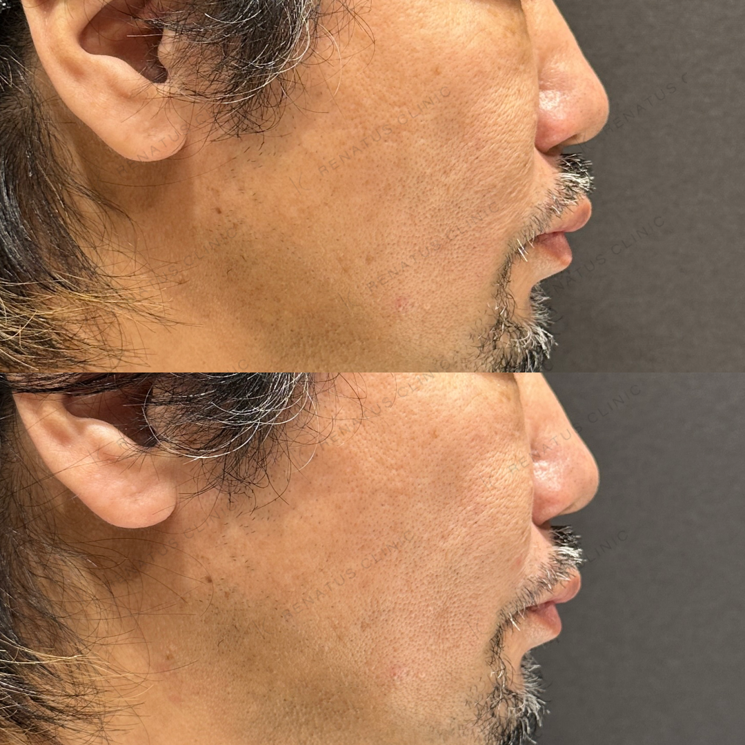 鼻翼基部ヒアルロン酸ボリフト症例写真