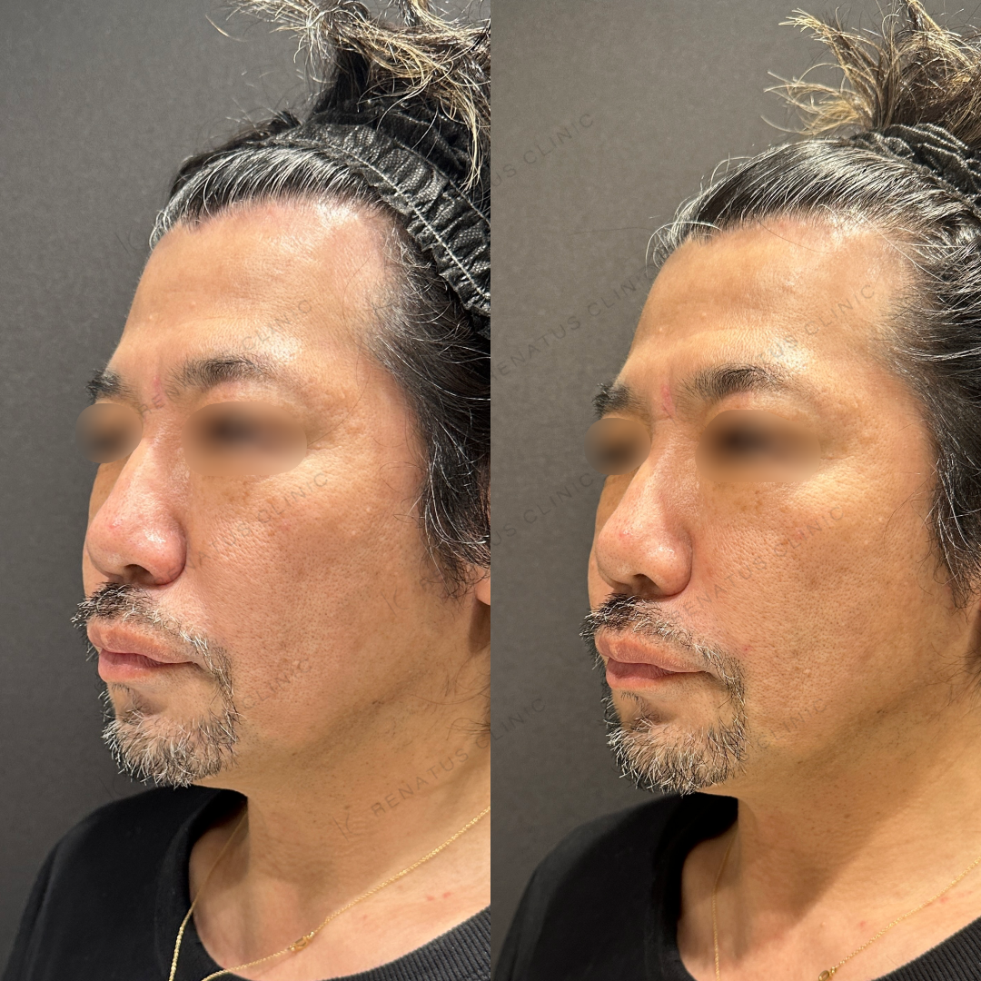 鼻翼基部ヒアルロン酸ボリフト症例写真
