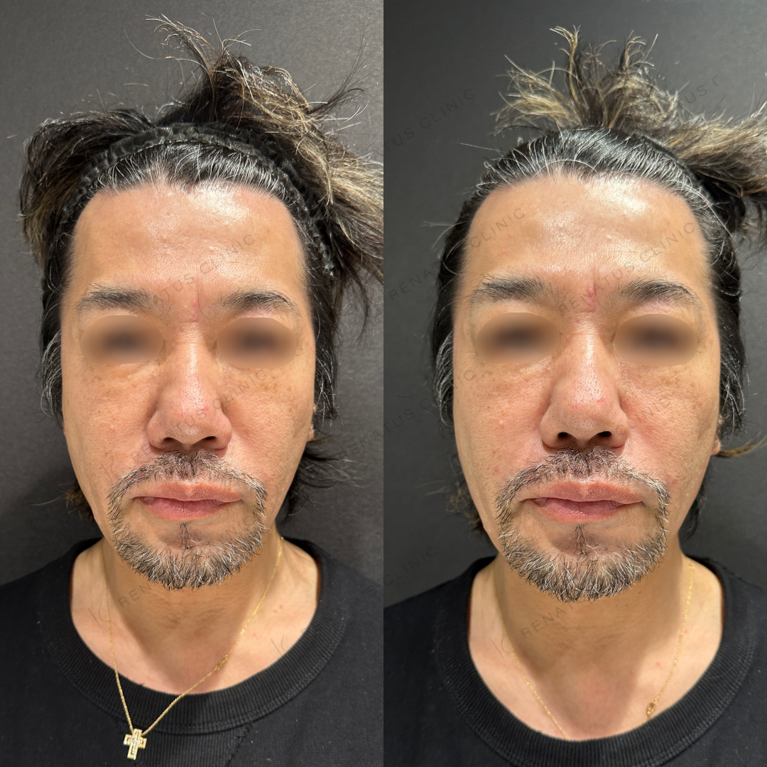 鼻翼基部ヒアルロン酸ボリフト症例写真