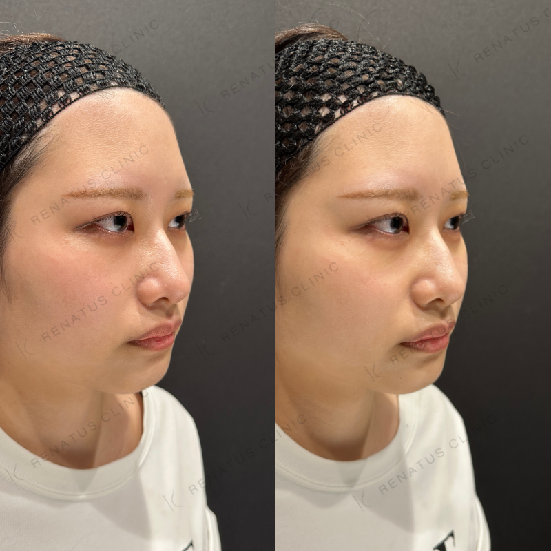 涙袋ヒアルロン酸ボルベラ症例写真